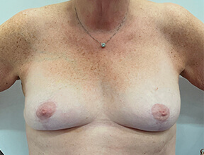 Breast Reduction - After